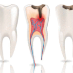 Why Choosing an Endodontist Makes All the Difference for Complex Root Canal Cases