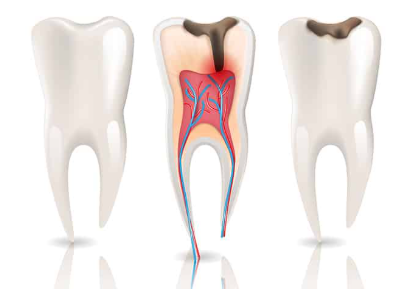 Why Choosing an Endodontist Makes All the Difference for Complex Root Canal Cases